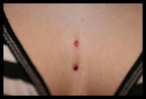 Featured image of post Scar Sternum Dermal Piercing The piercing might tear off due to accidental rubbing of the jewelry especially while changing clothes causing scars